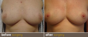Inverted nipples before and after surgery