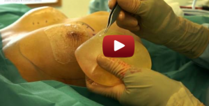 PIP breast implants being removed and replaced