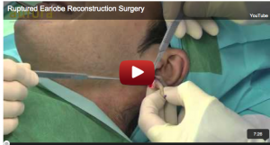 Tribal ear correction procedure