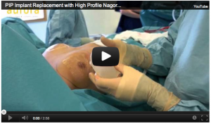Video: Removal and replacement of PIP breast implants