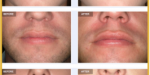 Aurora Clinics: Photo showing Permalip Before and After