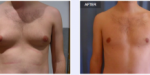 Aurora Clinics: Gynecomastia Surgery Before and After