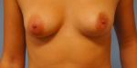 Aurora Clinics: Tuberous breasts - how do you know if you have them?