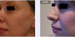 Aurora Clinics: Photo showing Rhinoplasty (Nose Job) Profile Before and After