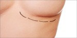 Aurora Clinics: Photo of OCEAN™ Breast Enlargement Surgery