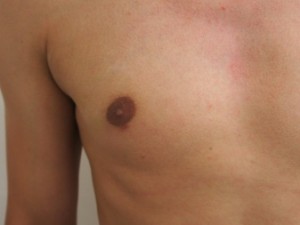Aurora Clinics: Photo After Nipple Reduction Surgery