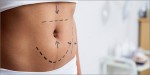 Aurora Clinics: Photo of Mini Tummy Tuck Surgery