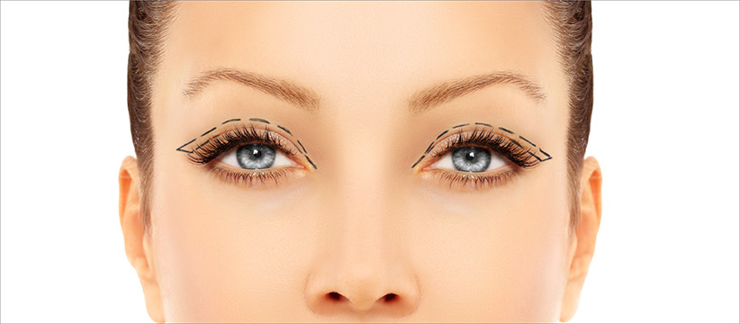 Aurora Clinics: Photo of Blepharoplasty Surgery