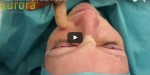 Aurora Clinics: Video of Upper Eyelid Surgery