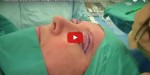 Aurora Clinics: Video of Live Eyelid Correction Surgery