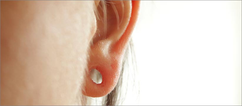 Aurora Clinics: Stretched Earlobe Repair