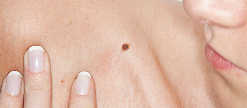 Aurora Clinics: Photo of Mole Removal Surgery