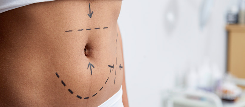 Aurora Clinics: Photo of Mini Tummy Tuck Surgery