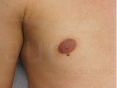 Before-Skin Lesion