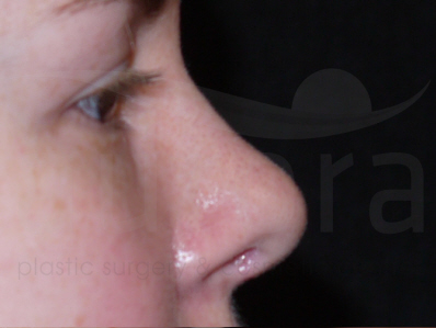 After-Rhinoplasty 