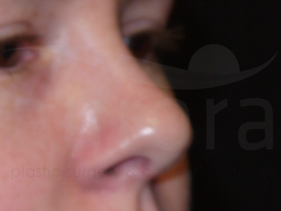 After-Rhinoplasty