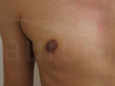 After-Skin Lesion