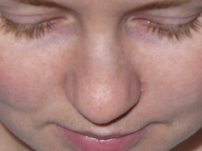 Before-Rhinoplasty