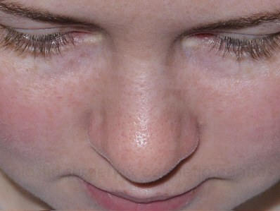 After-Rhinoplasty