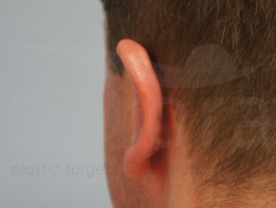 After-Ear pinning