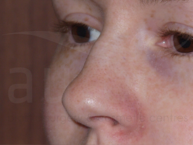 Before-Rhinoplasty