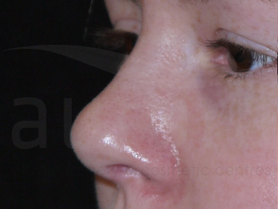 After-Rhinoplasty