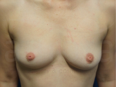 Before-Breast Enlargement