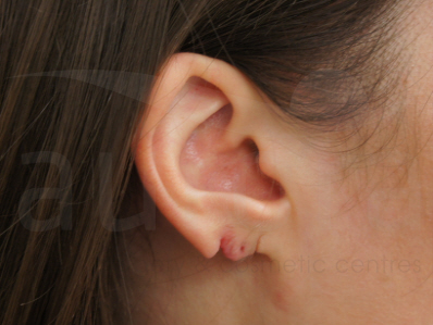 Before-Split Earlobe repair