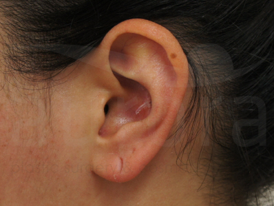 Before-Earlobe repair