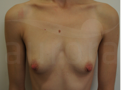 Before-Tuberous Breast Correction