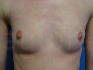 Before-Breast Enlargement