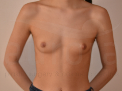 Before-Breast Enlargement 