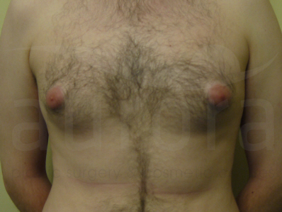 Before-Gynecomastia