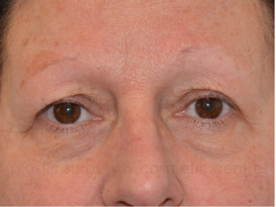 Before-Eyelid surgery