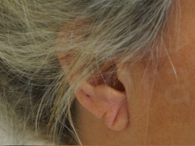 Before-Split earlobe