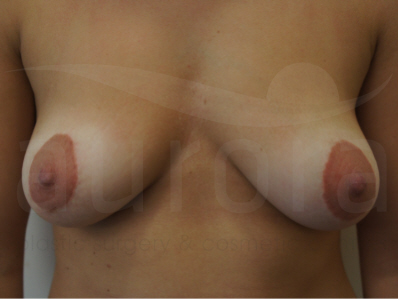 Before-Areola Reduction