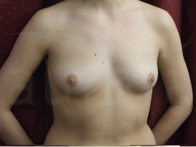 Before-Breast Enlargement