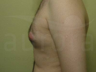 Before-Gynecomastia