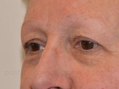 Before-Eyelid surgery