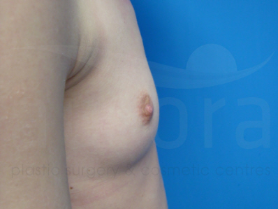 Before-Breast Enlargement