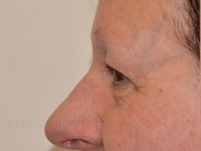 Before-Eyelid surgery