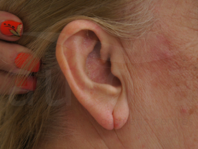 Before-Earlobe repair