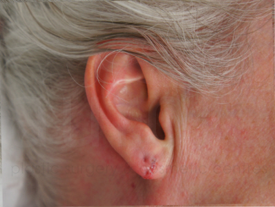 After-Split Earlobe