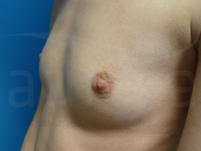 Before-Breast Enlargement