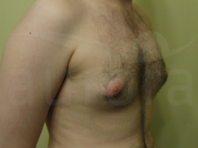 Before-gynecomastia