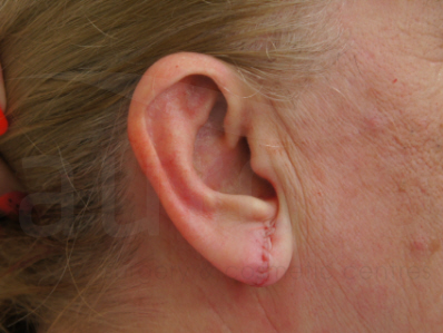 After-Earlobe repair