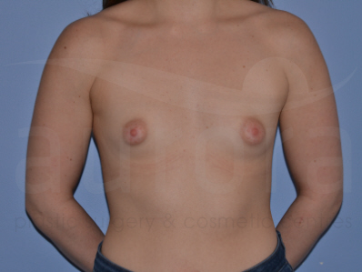 Before-Tuberous breasts