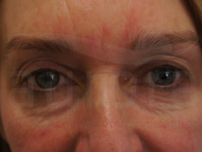 Before-Eyelid Surgery