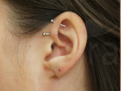 Before-Split earlobe repair