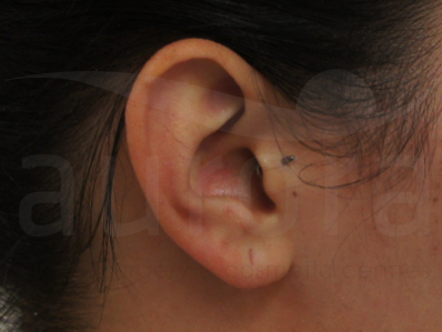 Before-Earlobe repair